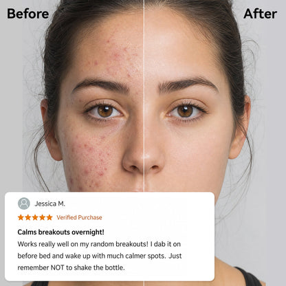 Korean 3H Overnight Drying Lotion- Targeted Spot Care for Troubled & Oily-Prone Skin