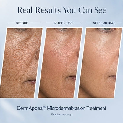 Microdermabrasion Treatment w/ V5 Crystal Technology Facial Exfoliate