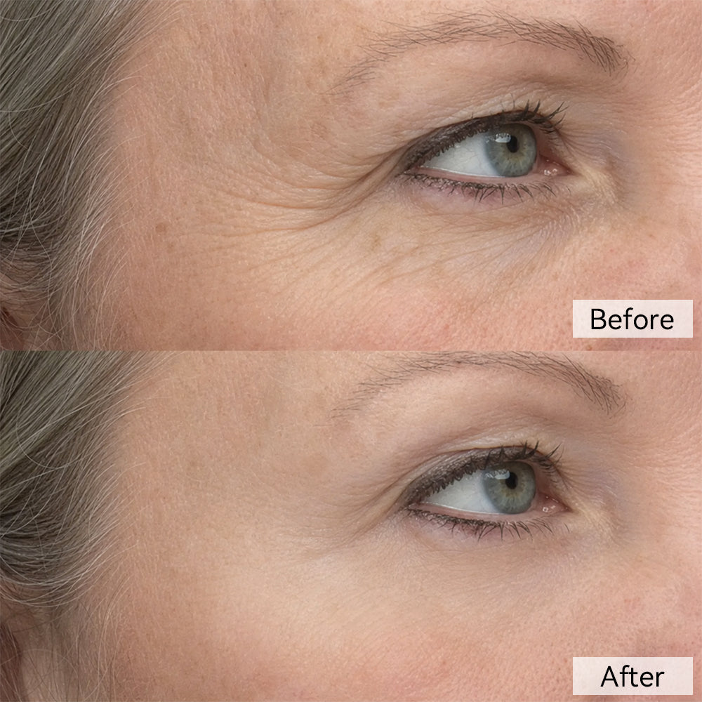 Before and after result showing the appearance of crow's feet