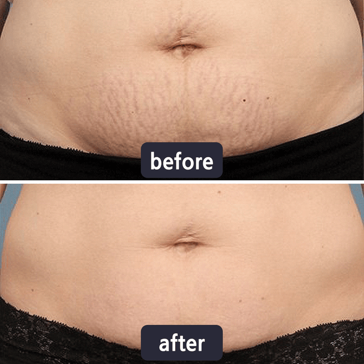 Purelums Scar Removal Cream