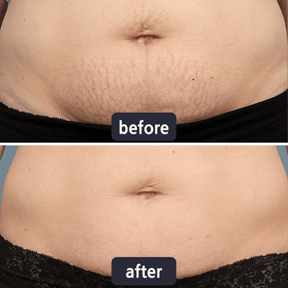 Purelums Scar Removal Cream