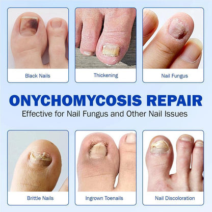 Fungal Nail Repair Patches