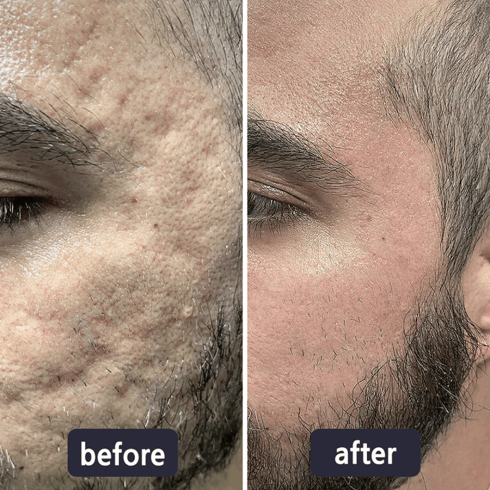 Purelums Scar Removal Cream