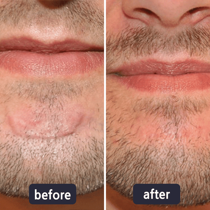 Purelums Scar Removal Cream