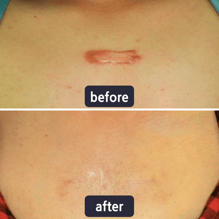 Purelums Scar Removal Cream