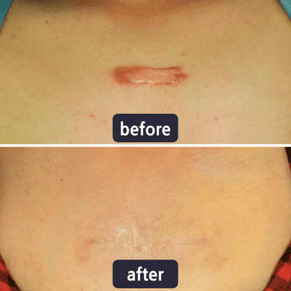 Purelums Scar Removal Cream