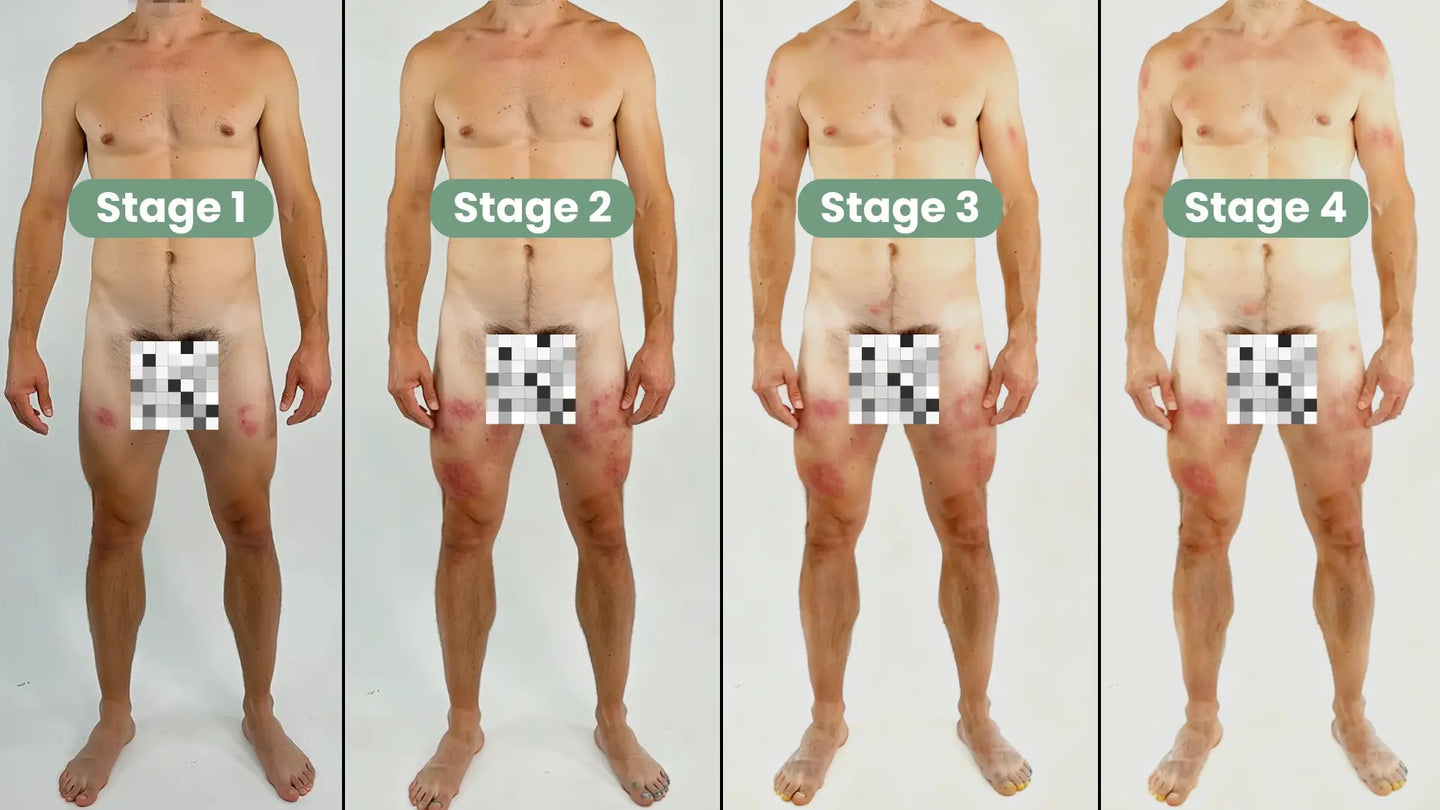jock_itch_stages.jpg